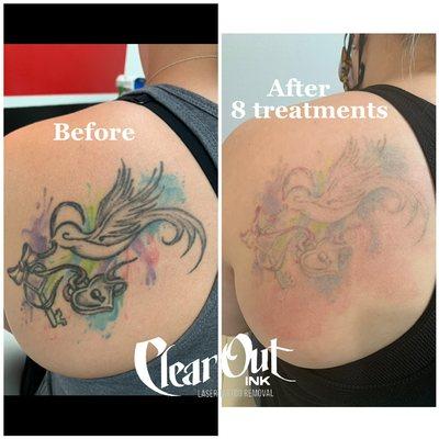 Clear Out Ink Laser Tattoo Removal Llc