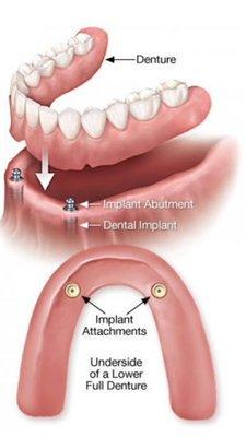 Implant Supported Dentures