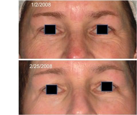 Skin Tightening Eyes