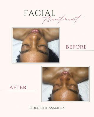 after glow facial with a focus on resurfacing