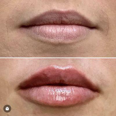 Before & After
Lip Filler & BeautySmart Skincare's LipTide