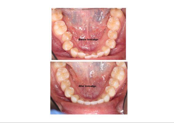 Invisalign before and after