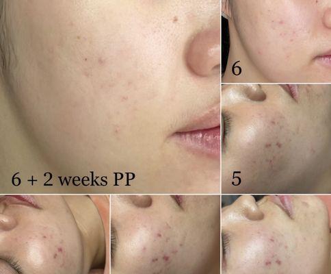 : After 6 treatments of microdermabrasion and using the right products the pigmentation from acne scarring was lifted and lighten.