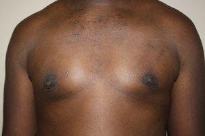 After Gynecomastia procedure