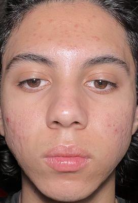 This is Before where I had inflamed acne - July 2023