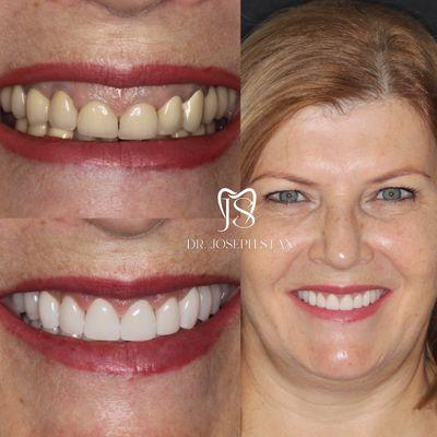 Dental Implants at Smile Boutique