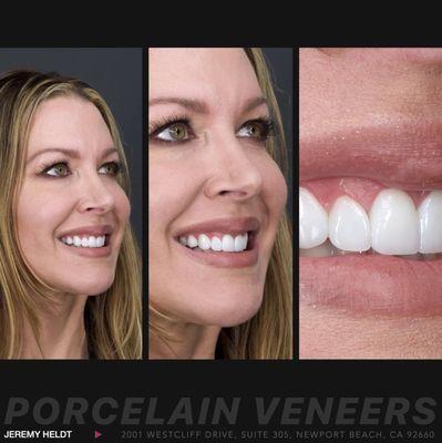 8 Porcelain Veneers in Shade OM1.  Endless color and detail.