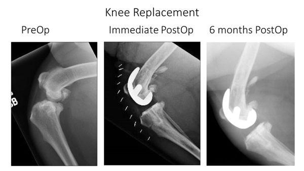 Knee Replacement