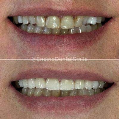 Limited smile makeover using porcelain veneers!