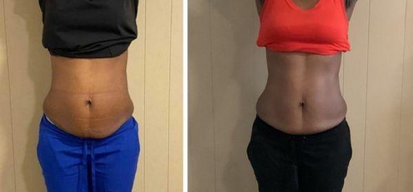 Slimming and toning with Cavitation