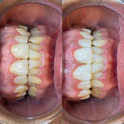 Teeth whitening results