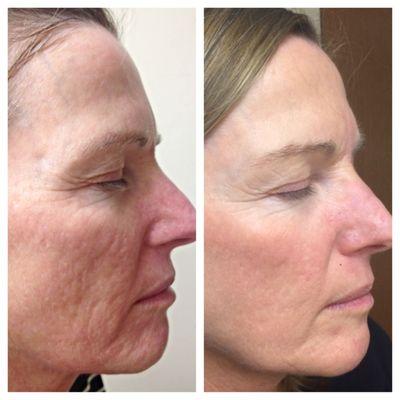 Before and after  microneedling