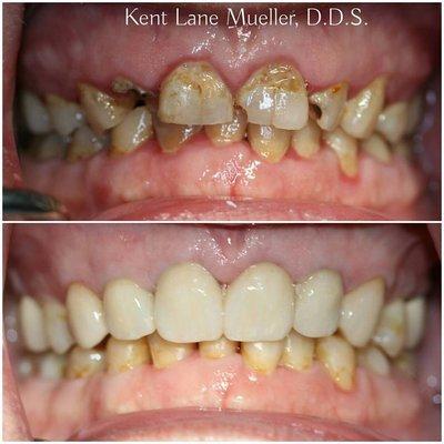 Complete Smile Makeover