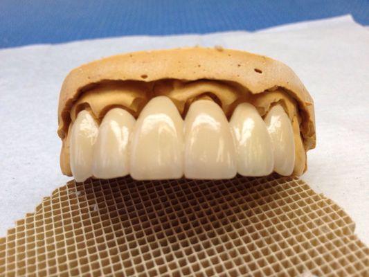 Layered Zirconia bridge