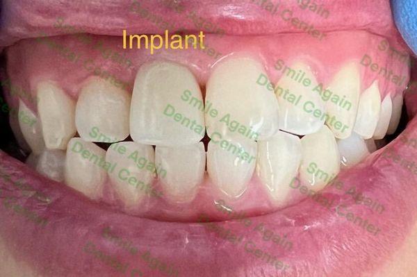 Single anterior Implant by Dr.John Kim & Smile Again Dental Center Lab