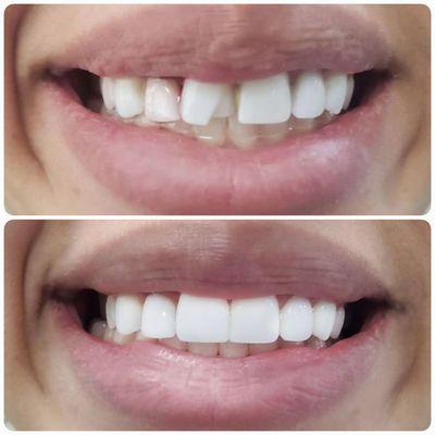 Before & After 
A new beautiful smile
By Dr. Brian Kim