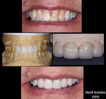 This patient was self-conscious since his teeth became discolored. Lifelike porcelain veneers helped him regain confidence and smile wider.