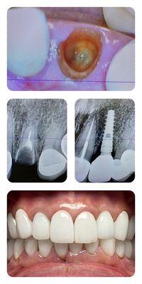 Dental implant tooth #10