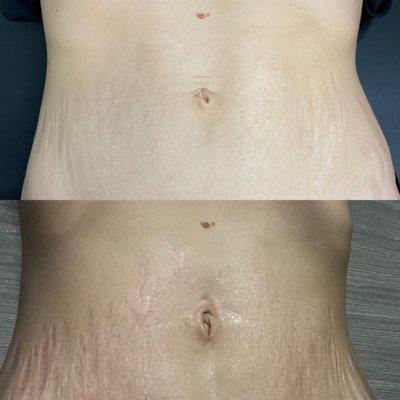 Baby Belly tightening and smoothing out stretch marks.