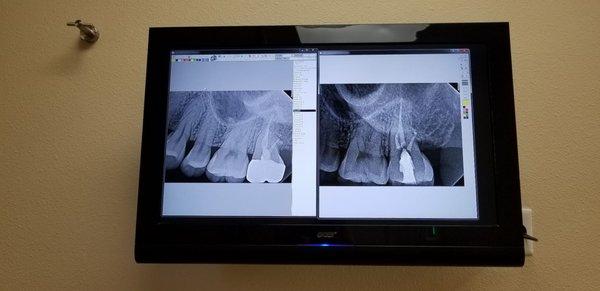 My root canal and crown treatment..left image is before and right is after. I dont have any pains anymore! Thank you Dr Chen!