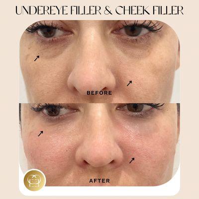 Under eye filler and cheek filler before and after