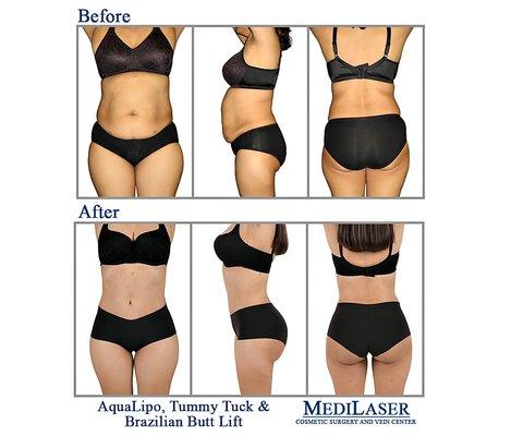 Aqualipo-Lipo-Liposculpture-Brazilian-Butt-Lift-Tummy-Tuck-Cosmetic-Surgeon-Dr-Giraldo