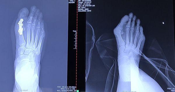 Right foot-- severe bunion...