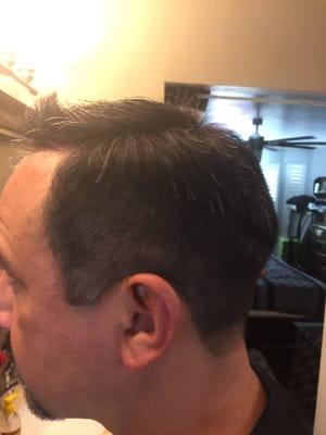 New customer, no previous hair on top.  After hair replacement.