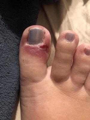 Pedicure infection