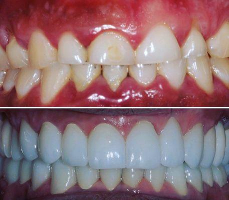 Full Mouth Construction using Zirconia Crowns