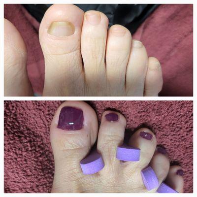 Toenail Reconstruction- a healthy alternative to acrylic extension #toenailrepair #callustreatment #medipedi