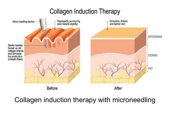 Microneedling skin map