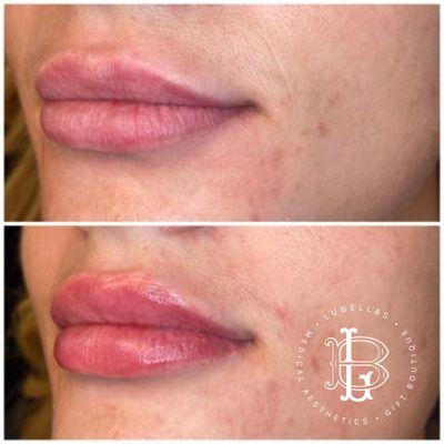 Lip Filler Benefits: Restore previous lip size.   Correct the shape of your lips.  Boosting confidence. Smooth wrinkles.