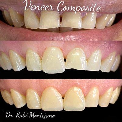 Composite Veneers done in 1 appointment!