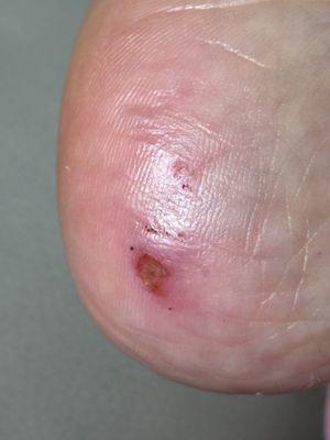 Heel infection