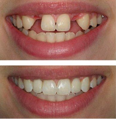 Implant restorations on missing lateral incisors