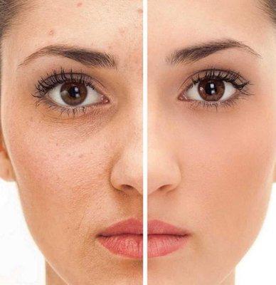 Montville MedSpa & Pain Center Acne Treatments