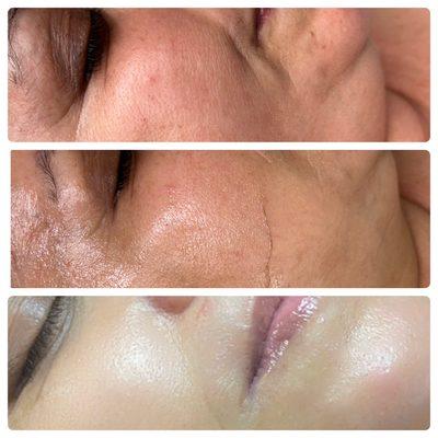 Dermaplane pro facial