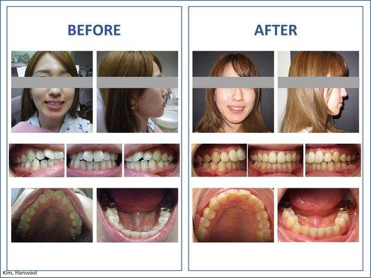 One of our successful invisalign patient's Before & After