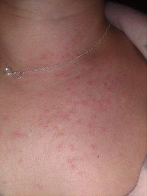 Rash from infection