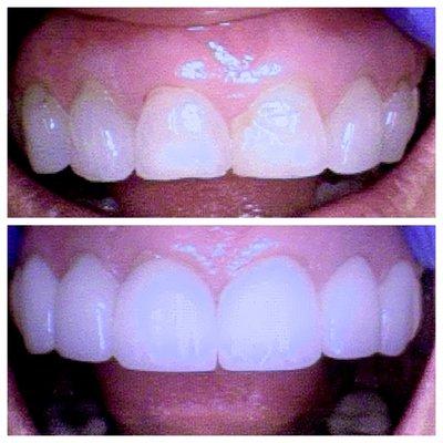 6 unit porcelain veneers