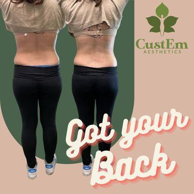 Back body Sculpting