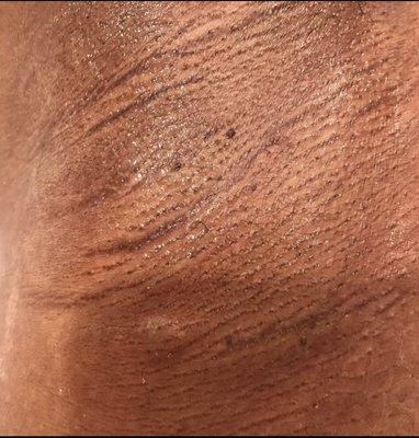 Underarm after sugaring