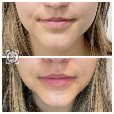 Before and two weeks after lip filler.