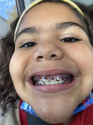 My daughter getting braces