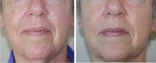 Filler on Nasolabial: Before and after