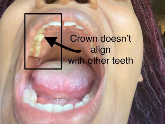 Crown misalignment in mouth