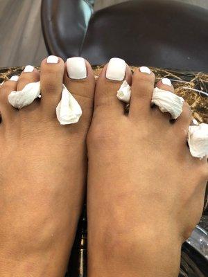 Uneven toe nails