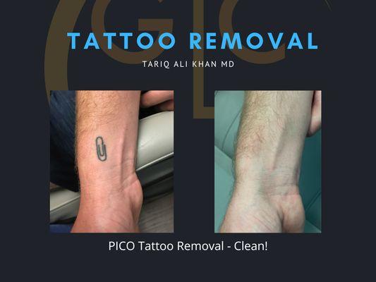 Clean Tattoo Removal - PICO laser