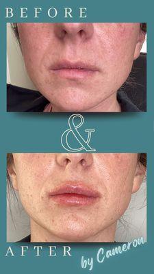 Lip enhancement with Restylane